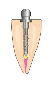 16may5bcmusikant Overdenture03 16may5bcmusikant Overdenture03