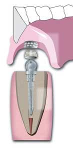 16may5bcmusikant Overdenture04 16may5bcmusikant Overdenture04