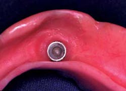 16may5bcmusikant Overdenture05 16may5bcmusikant Overdenture05