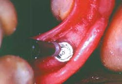 16may5bcmusikant Overdenture06 16may5bcmusikant Overdenture06