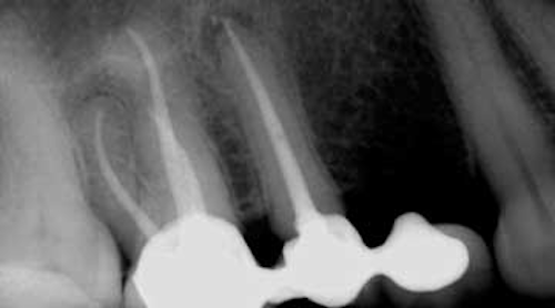 An Endodontist Answers 8 Questions Gps Ask About Root Canal Treatment Dentistry Iq