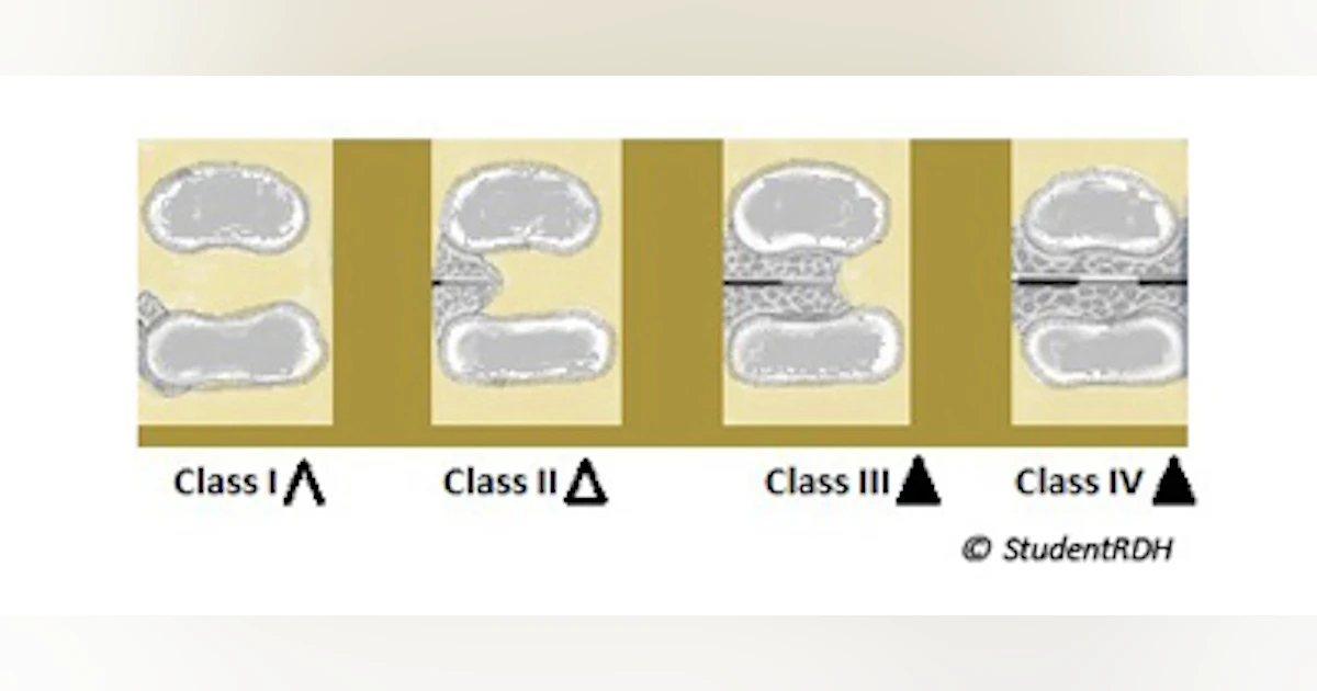 Furcation Classification Radiographs Summary of furcation defects for dental hygiene exams | Dentistry IQ