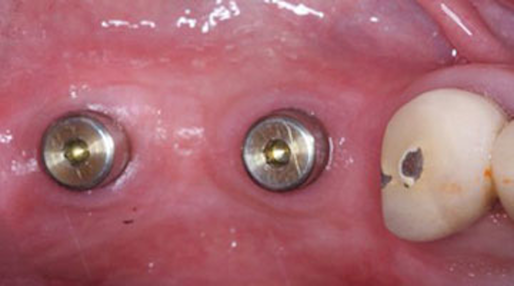 Dental coding with Kyle D6010—Surgical placement of implant body