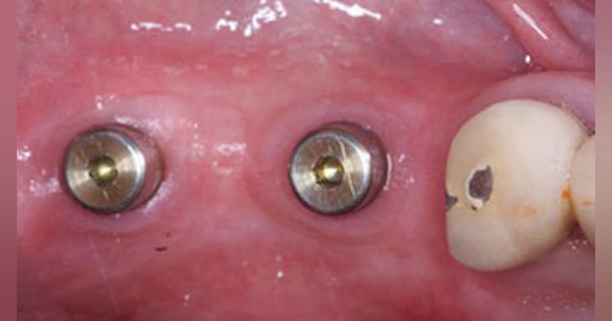 Dental coding with Kyle: D6010—Surgical placement of implant body