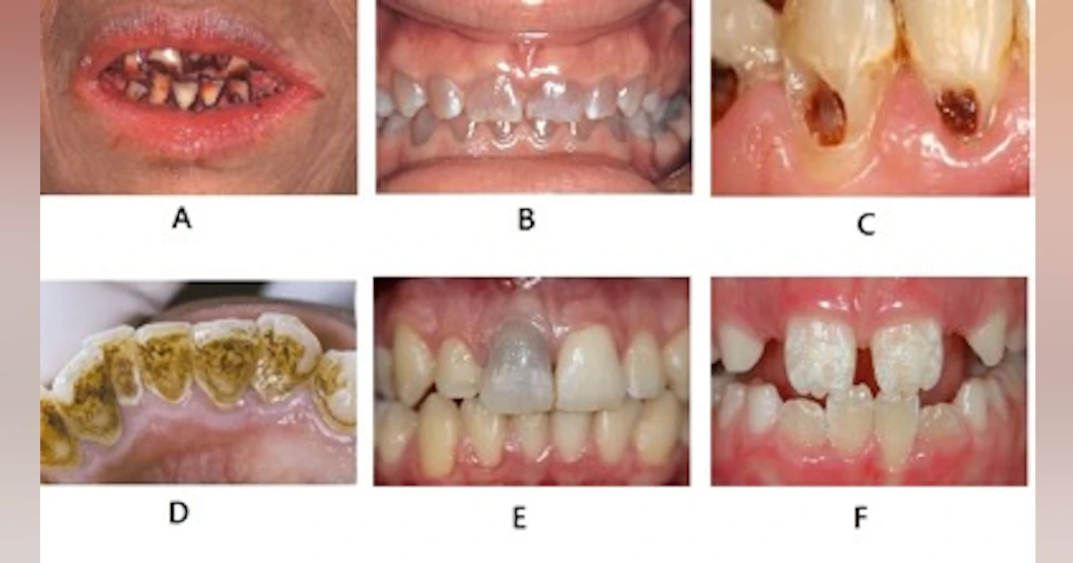Teeth Staining Summary By Color And Origin For The Dental Hygiene Exams teeth-staining-summary-by-color-and-origin-for-the-dental-hygiene-exams