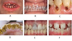 Teeth Staining chart Teeth Staining chart