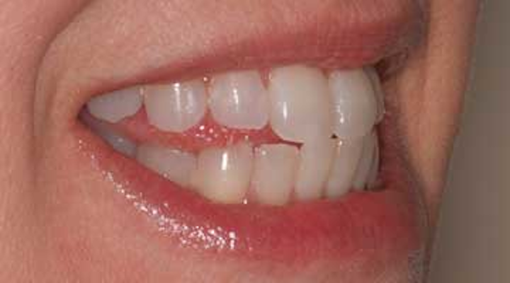 Managing Phonetic Complications Arising In Full Arch All On 4 Hybrid Cases Dentistryiq