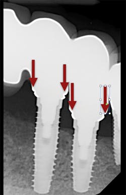 Pmm Pdt Implantimp Fig01 Pmm Pdt Implantimp Fig01