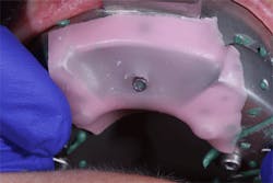 Pmm Pdt Implantimp Fig09 Pmm Pdt Implantimp Fig09