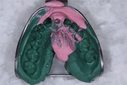 Pmm Pdt Implantimp Fig10 Pmm Pdt Implantimp Fig10