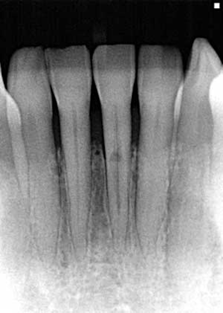 Internal Resorption Tooth
