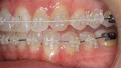 16aug4bcsimmons Braces 16aug4bcsimmons Braces