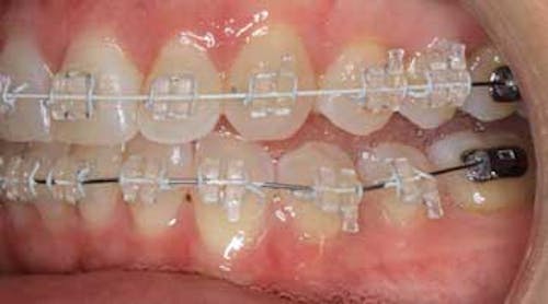 Bethany Orthodontics - Braces