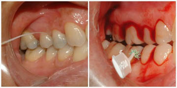 A new 'flossophy' exposes the myths surrounding the efficacy of flossing | DentistryIQ A new 'flossophy' exposes the myths surrounding the efficacy of flossing | DentistryIQ