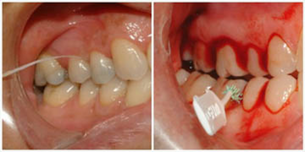 A new 'flossophy' exposes the myths surrounding the efficacy of flossing |  DentistryIQ