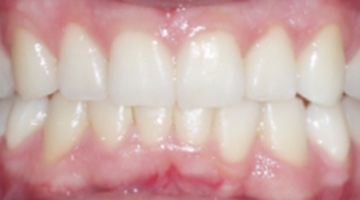 align your teeth