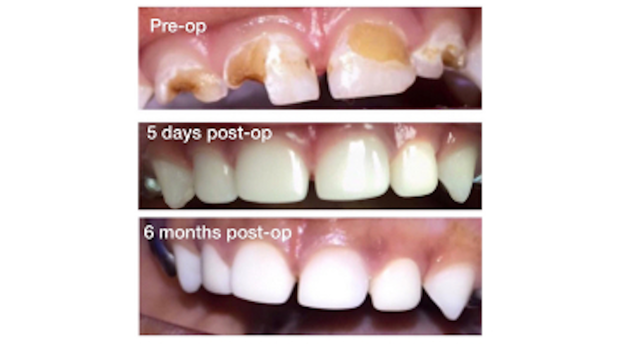 Restoring primary anterior teeth with EZ-Pedo all-ceramic zirconia crowns: 3 case studies
