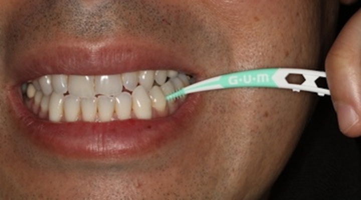 Alternatives to floss: A review of Sunstar Gum's Soft-Picks Advanced |  DentistryIQ