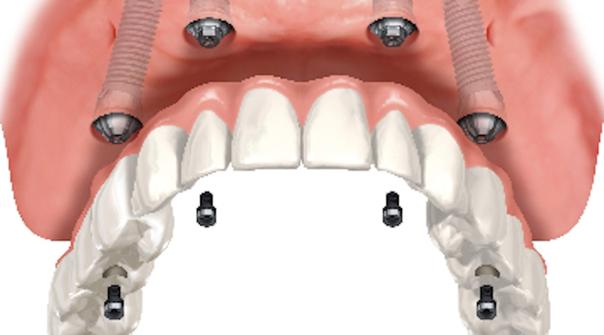 Full Arch Dental Implant Supported Bridges Why Offering Coverage May Save Medical Insurance Companies Money Dentistryiq