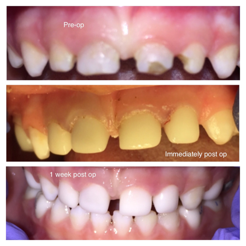 Restoring Primary Anterior Teeth With EZ-Pedo All-ceramic Zirconia ...