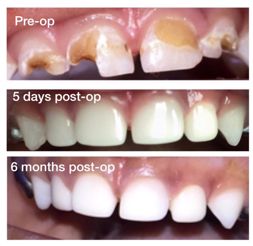 Restoring Primary Anterior Teeth With EZ-Pedo All-ceramic Zirconia ...