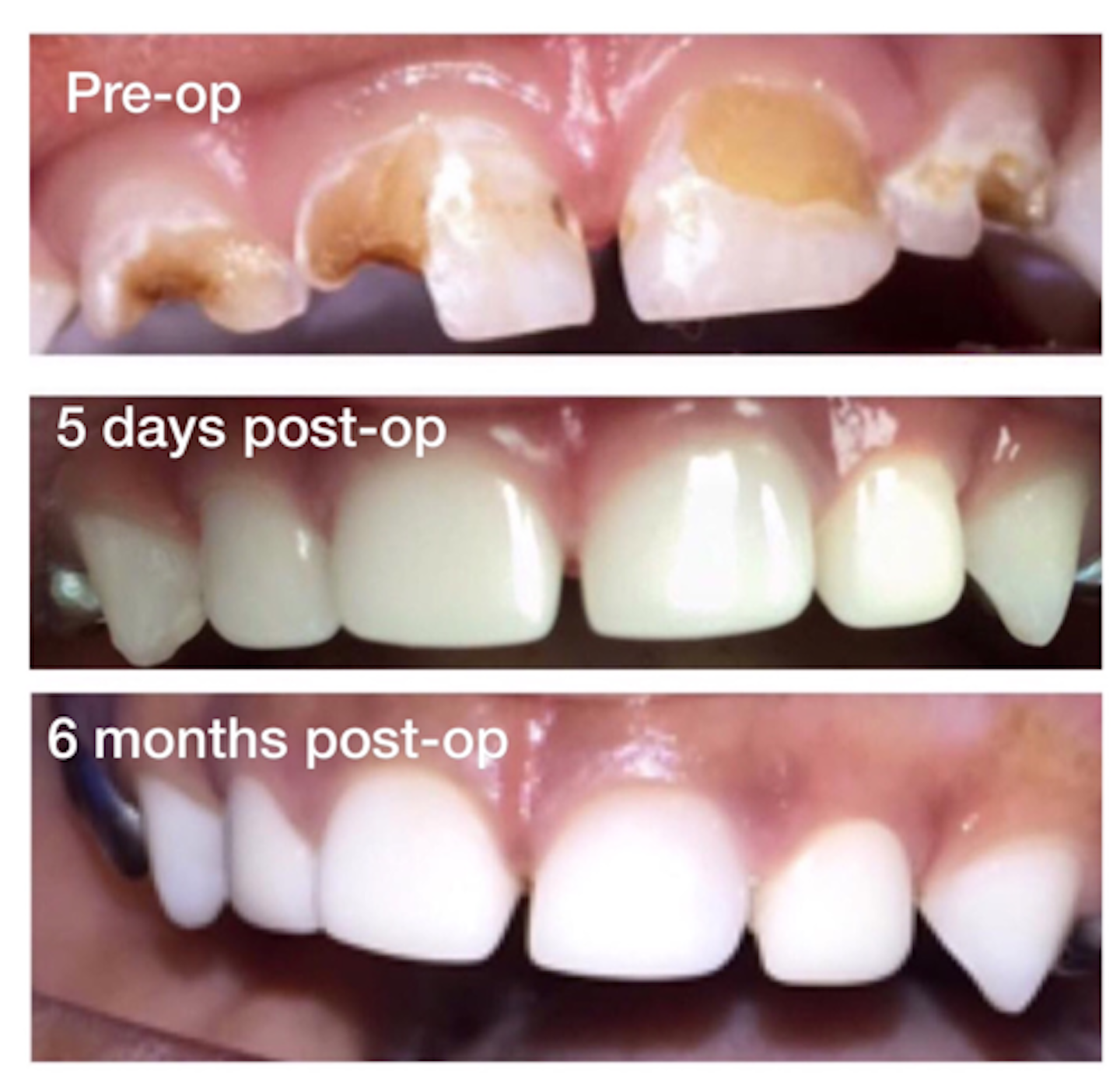 Restoring primary anterior teeth with EZ-Pedo all-ceramic zirconia ...