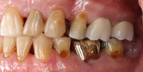 Alternatives to floss: A review of Sunstar Gum's Soft-Picks Advanced | DentistryIQ Alternatives to floss: A review of Sunstar Gum's Soft-Picks Advanced | DentistryIQ