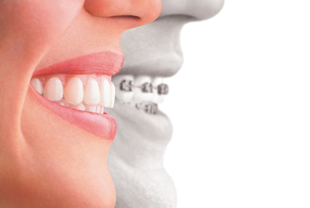 Clear aligners versus traditional braces: 4 benefits for adult