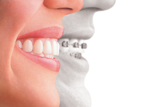 Clear Aligners Versus Traditional Braces 4 Benefits For Adult Orthodontic Patients Dentistryiq