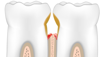 Content Dam Diq Online Articles 2016 10 Periodontal Disease Thumb