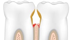 Content Dam Diq Online Articles 2016 10 Periodontal Disease Thumb Content Dam Diq Online Articles 2016 10 Periodontal Disease Thumb