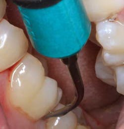 16feb04bc Nonsurgical Perio Tx02 16feb04bc Nonsurgical Perio Tx02