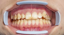 Content Dam Diq Online Articles 2016 11 Fluorosis Diqthumb Content Dam Diq Online Articles 2016 11 Fluorosis Diqthumb