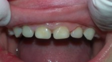 Heroic pediatric dentistry Strip crowns for Leigh Dentistry IQ