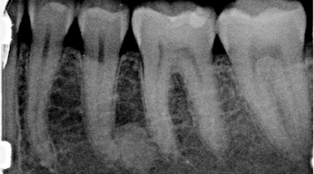 Diagnosis and treatment for Breakthrough Clinical oral pathology case