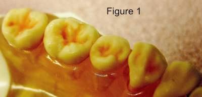 Quadrant sealants Examples of practical placement of dental sealants