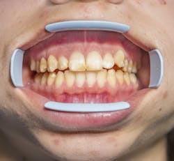 Fluorosis Fluorosis