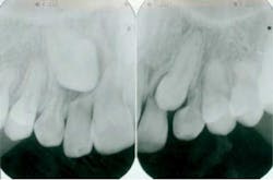 Root Resorption Root Resorption