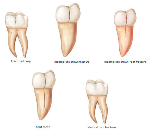 Cracked tooth symptoms