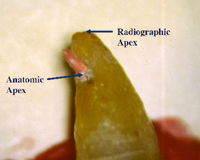 Root canal treatment Where does the apex end? DentistryIQ