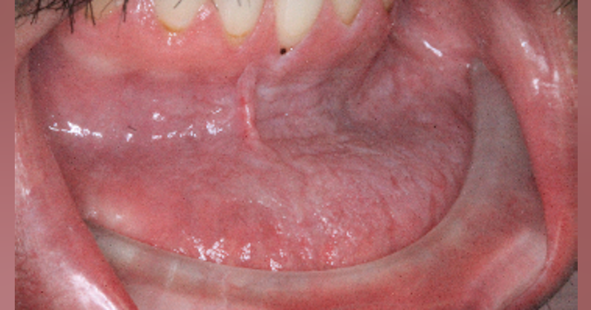 Diagnosis and treatment for Breakthrough Clinical oral pathology case