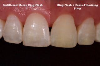 Cross-polarized reflective light dental photography: The silver