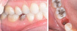 Bencharit Implant Form2 Fig07 Bencharit Implant Form2 Fig07