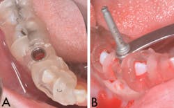 Bencharit Implant Form2 Fig08a08b Bencharit Implant Form2 Fig08a08b