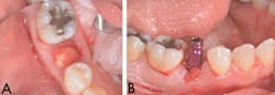 Bencharit Implant Form2 Fig09a09b Bencharit Implant Form2 Fig09a09b