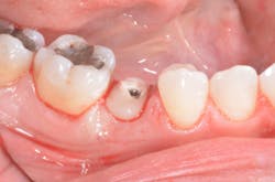 Bencharit Implant Form2 Fig10 Bencharit Implant Form2 Fig10