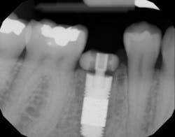 Bencharit Implant Form2 Fig11 Bencharit Implant Form2 Fig11