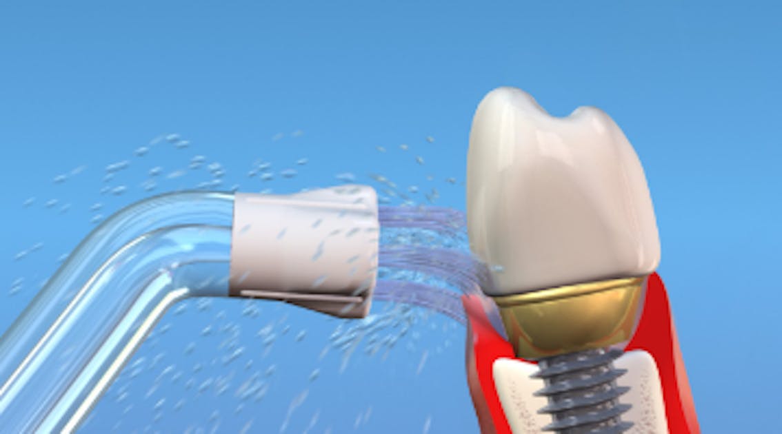 Ontaarden Rationalisatie dinsdag Enhancing dental implant health by water flossing with the Plaque Seeker tip  | Dentistry IQ
