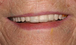 Avadent Fig06 Avadent Fig06