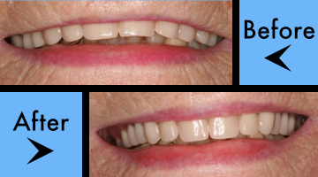digital techniques for creating partial dentures